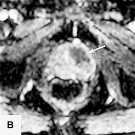 Axiales MRT-Bild (ADC-Maps), die das Karzinom im anterioren Bereich der Prostata zeigen (Pfeil).