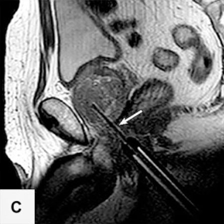 Sagittales und axiales MRT-Bilde mit der Biopsienadel (Pfeile) im Karzinomeherd.
