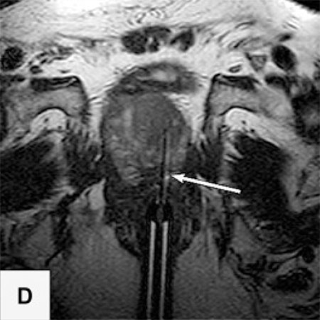 Sagittales und axiales MRT-Bilde mit der Biopsienadel (Pfeile) im Karzinomeherd.