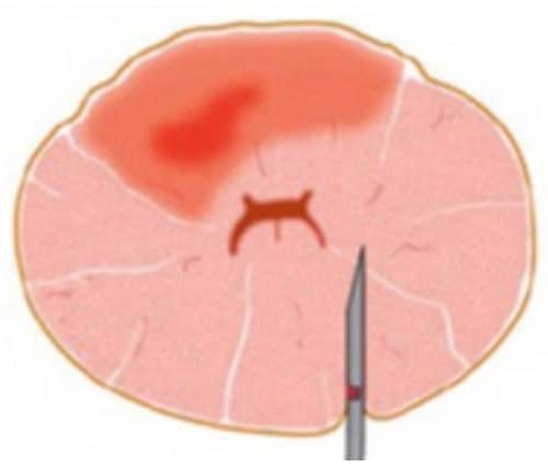 Biopsienadel verfehlt das Karzinom