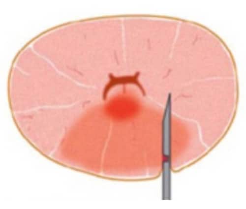 Biopsienadel verpasst aggressiven Anteil des Krebsherdes