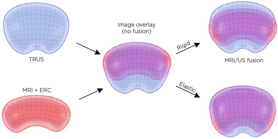 Prostata Verformung führt zu Problemen bei der Analyse