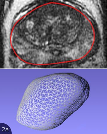 Prostata Verformung führt zu Problemen bei der Analyse