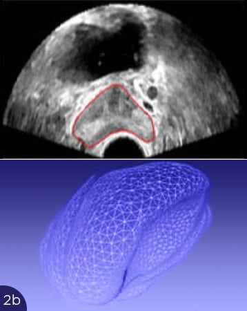 Prostata Verformung führt zu Problemen bei der Analyse