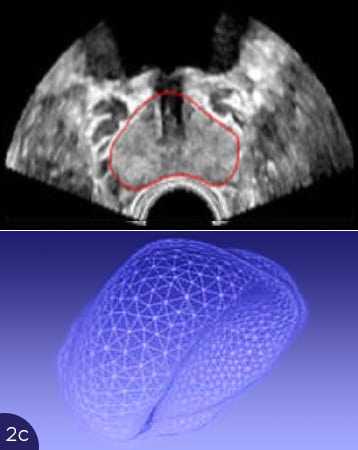 Prostata Verformung führt zu Problemen bei der Analyse