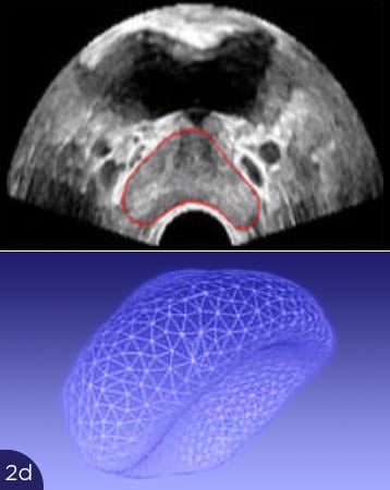 Prostata Verformung führt zu Problemen bei der Analyse